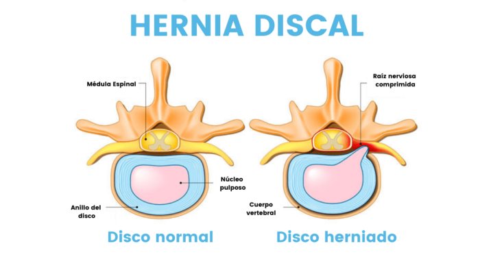 Hernia Discal - Fisioterapia
